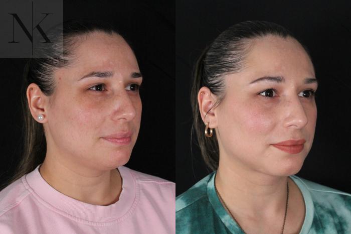 Before & After Isolated Deep Neck Lift Case 120 Right Oblique View in Wethersfield, Hartford, Nebraska