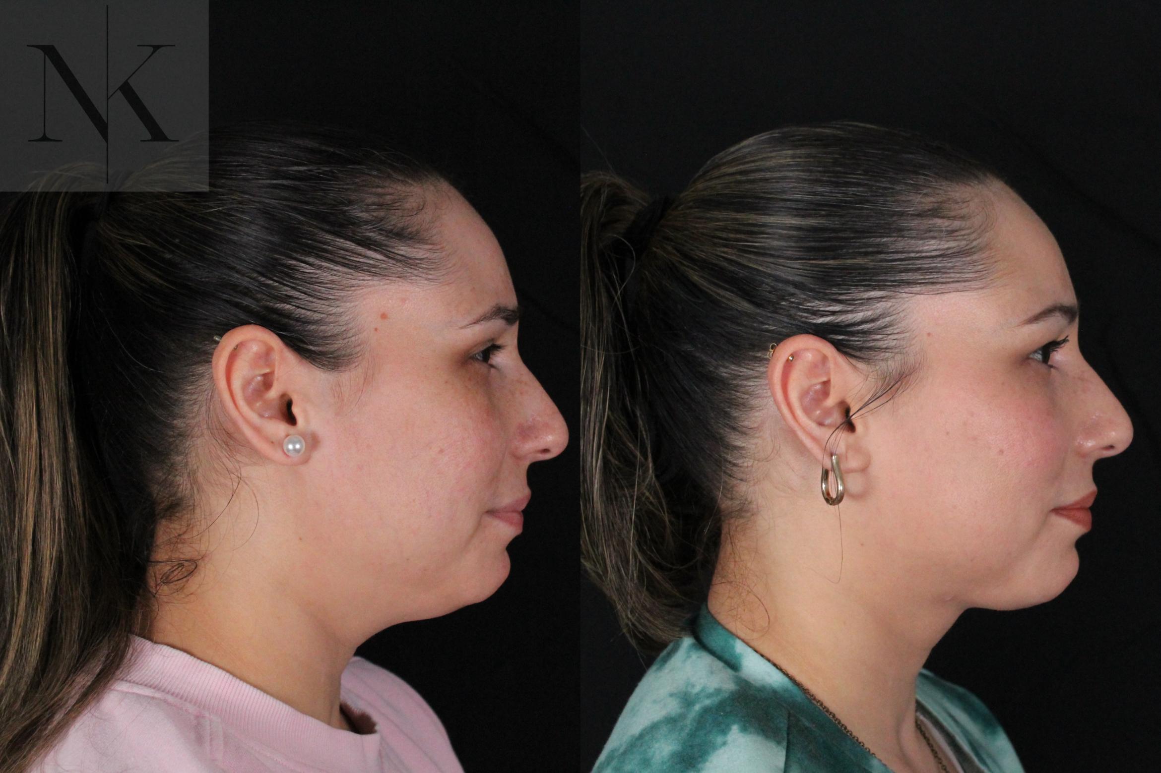 Before & After Isolated Deep Neck Lift Case 120 Right Side View in Wethersfield, Hartford, Nebraska