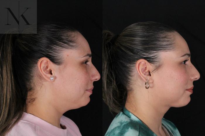 Before & After Isolated Deep Neck Lift Case 120 Right Side View in Wethersfield, Hartford, Nebraska