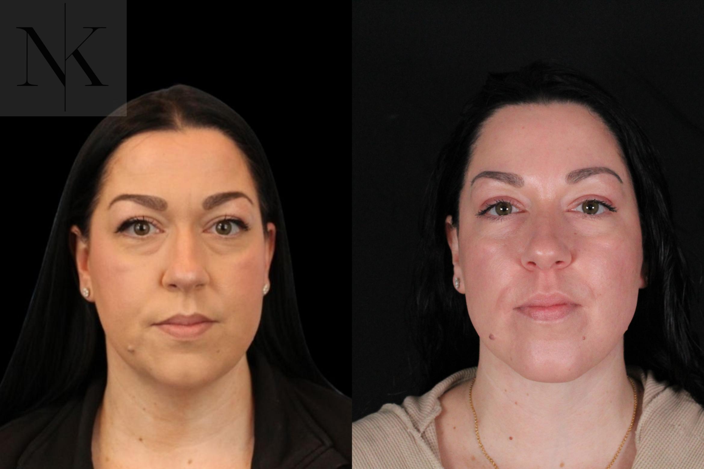 Before & After Isolated Deep Neck Lift Case 121 Front View in Wethersfield, Hartford, Nebraska