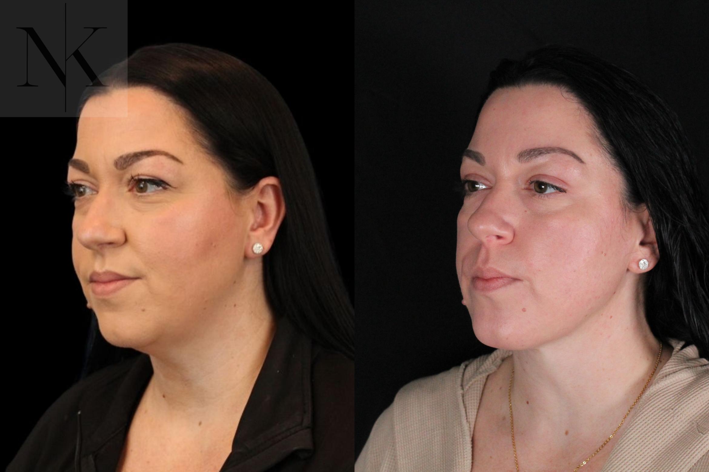 Before & After Isolated Deep Neck Lift Case 121 Left Oblique View in Wethersfield, Hartford, Nebraska