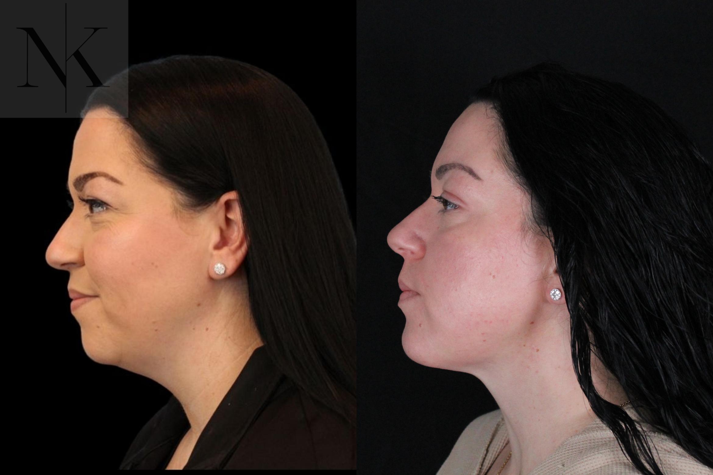 Before & After Isolated Deep Neck Lift Case 121 Left Side View in Wethersfield, Hartford, Nebraska