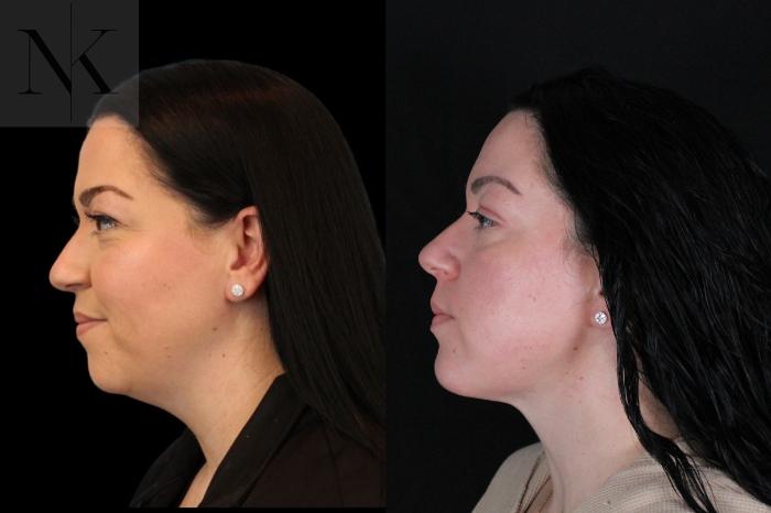 Before & After Isolated Deep Neck Lift Case 121 Left Side View in Wethersfield, Hartford, Nebraska