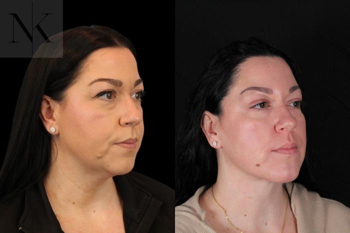 Before & After Isolated Deep Neck Lift Case 121 Right Oblique View in Wethersfield, Hartford, Nebraska