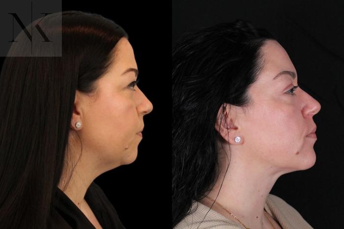 Before & After Isolated Deep Neck Lift Case 121 Right Side View in Wethersfield, Hartford, Nebraska