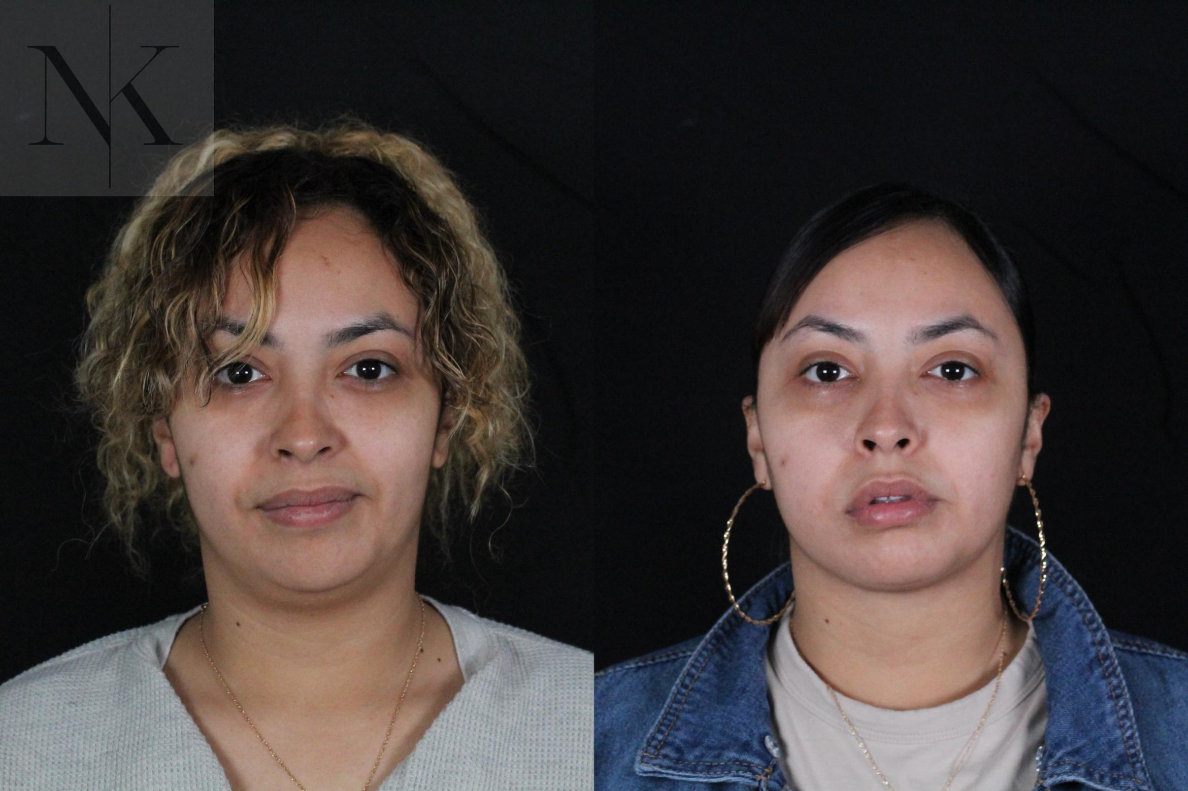 Before & After Isolated Deep Neck Lift Case 122 Front View in Wethersfield, Hartford, Nebraska