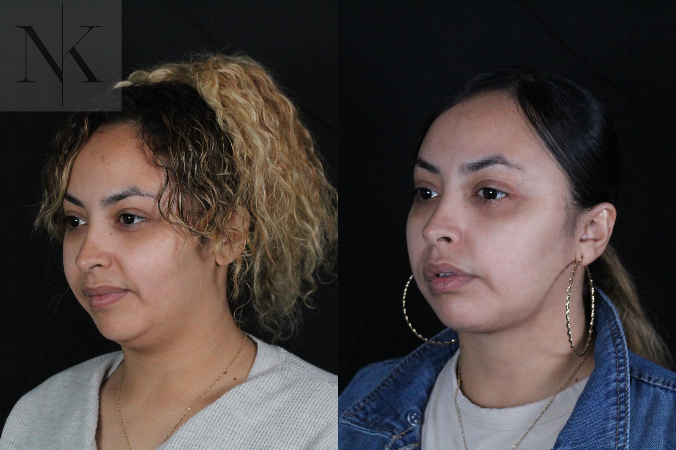 Before & After Isolated Deep Neck Lift Case 122 Left Oblique View in Wethersfield, Hartford, Nebraska