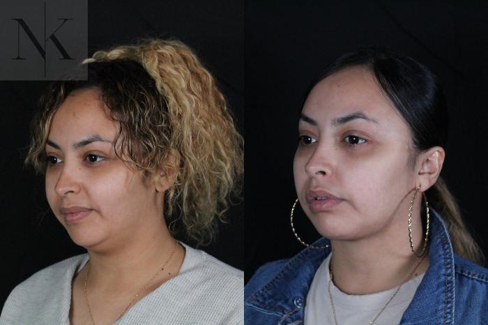 Before & After Isolated Deep Neck Lift Case 122 Left Oblique View in Wethersfield, Hartford, Nebraska