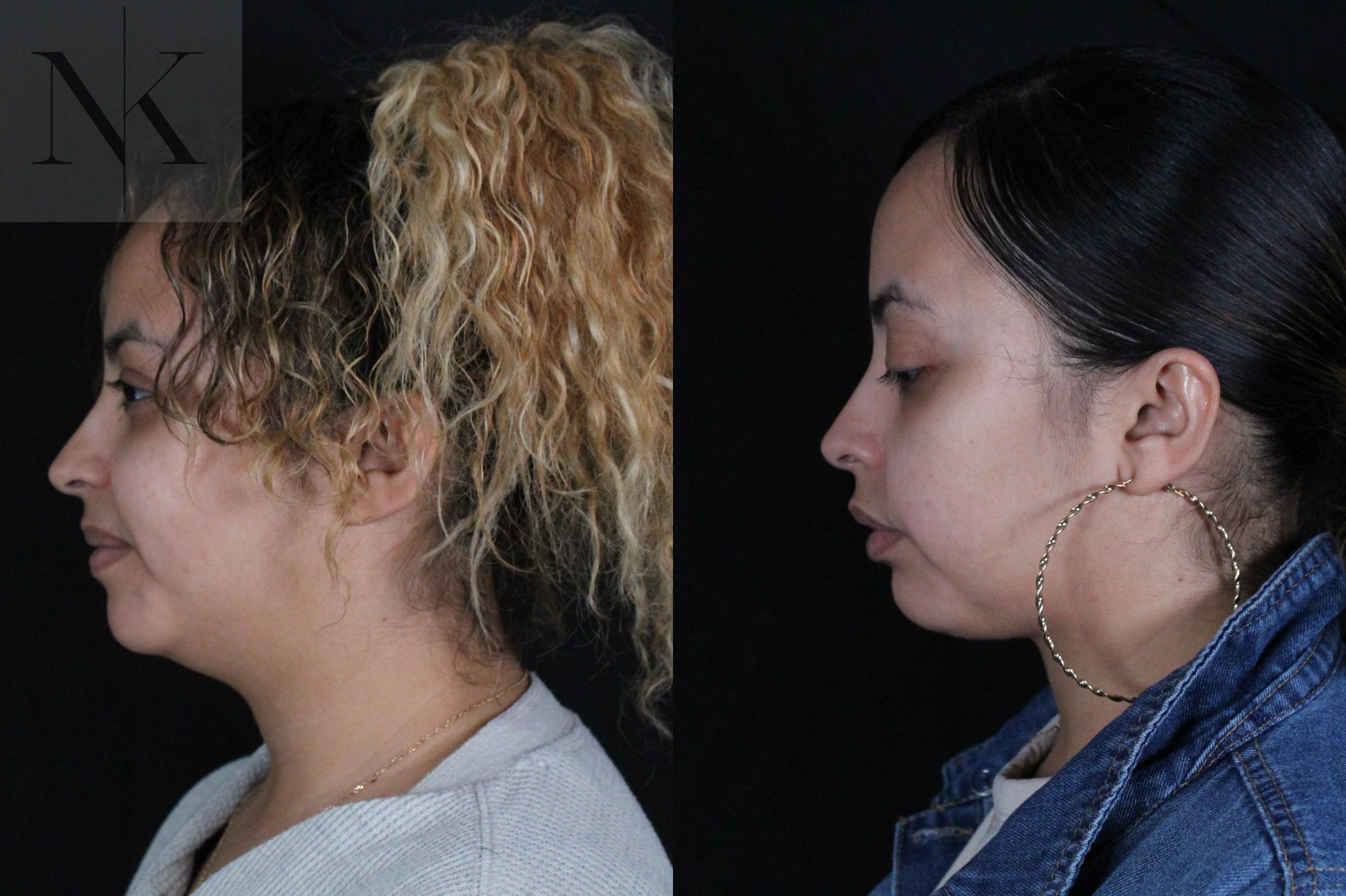 Before & After Isolated Deep Neck Lift Case 122 Left Side View in Wethersfield, Hartford, Nebraska