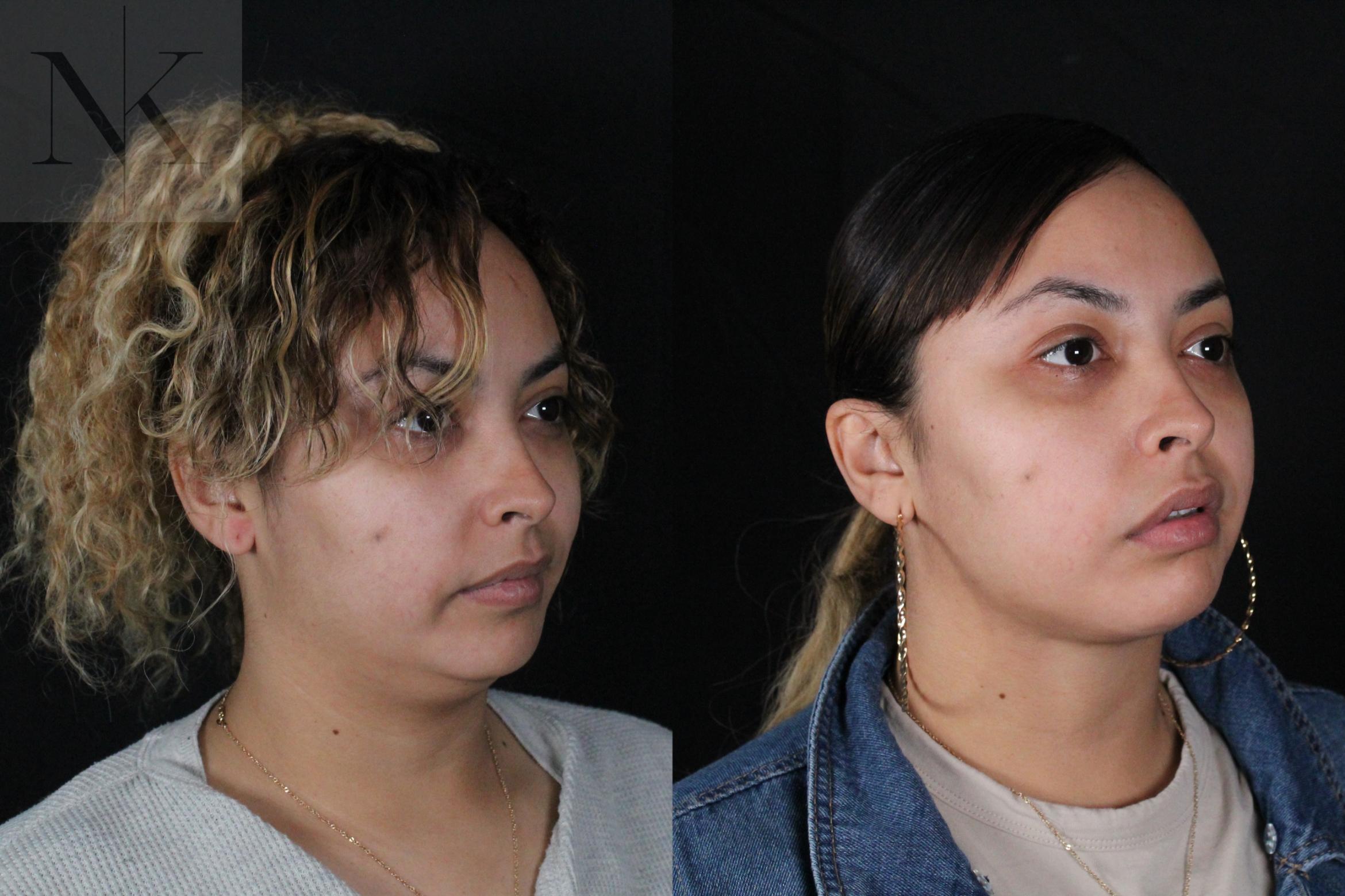 Before & After Isolated Deep Neck Lift Case 122 Right Oblique View in Wethersfield, Hartford, Nebraska