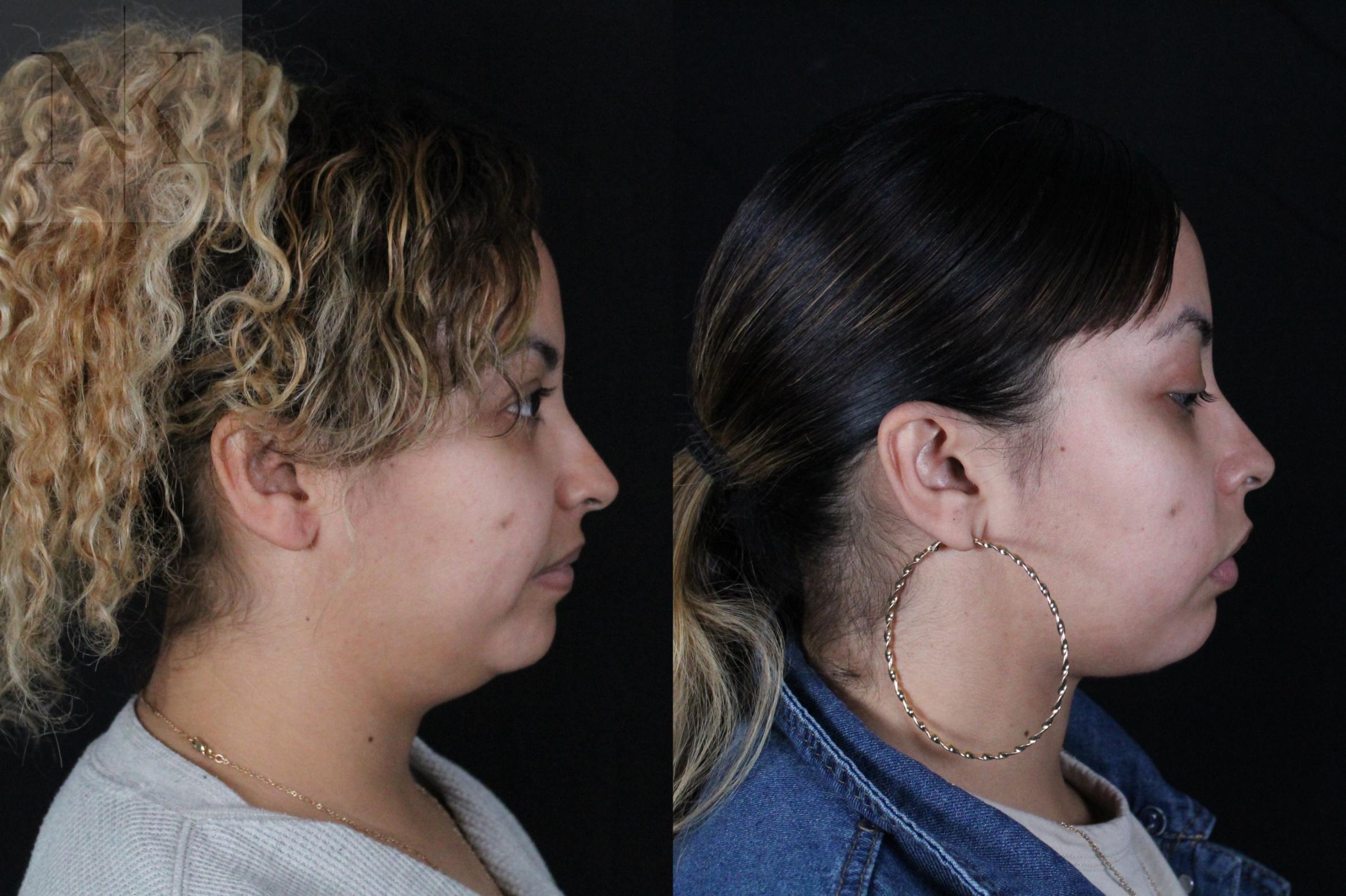 Before & After Isolated Deep Neck Lift Case 122 Right Side View in Wethersfield, Hartford, Nebraska