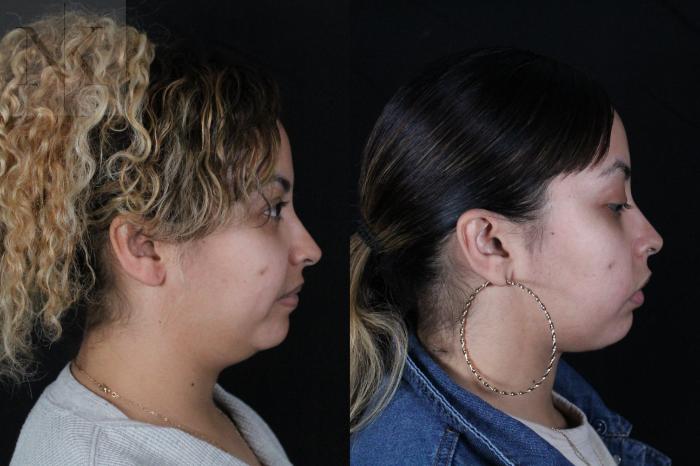 Before & After Isolated Deep Neck Lift Case 122 Right Side View in Wethersfield, Hartford, Nebraska