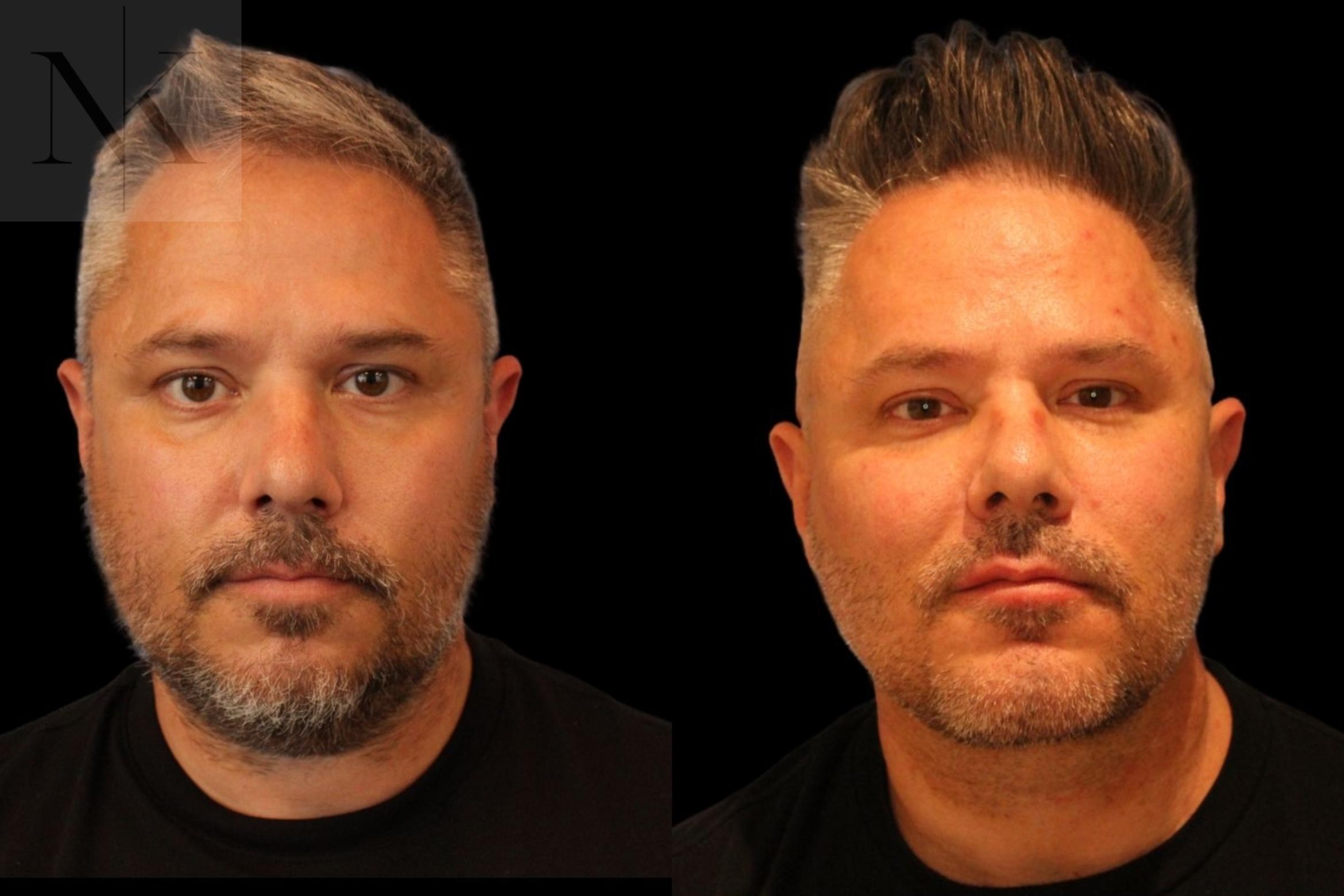 Before & After Isolated Deep Neck Lift Case 123 Front View in Wethersfield, Hartford, Nebraska