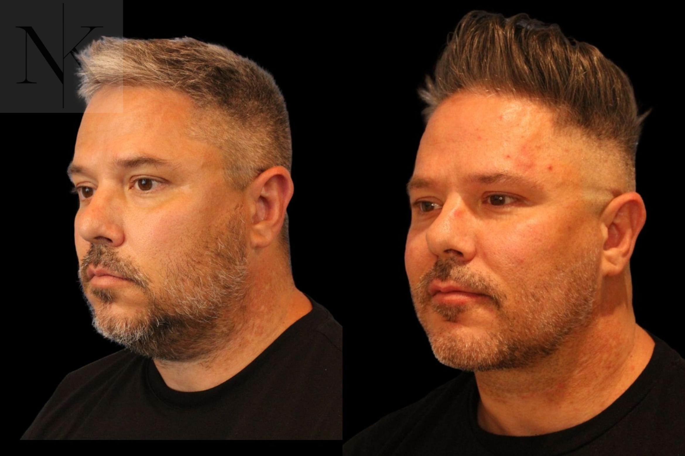 Before & After Isolated Deep Neck Lift Case 123 Left Oblique View in Wethersfield, Hartford, Nebraska