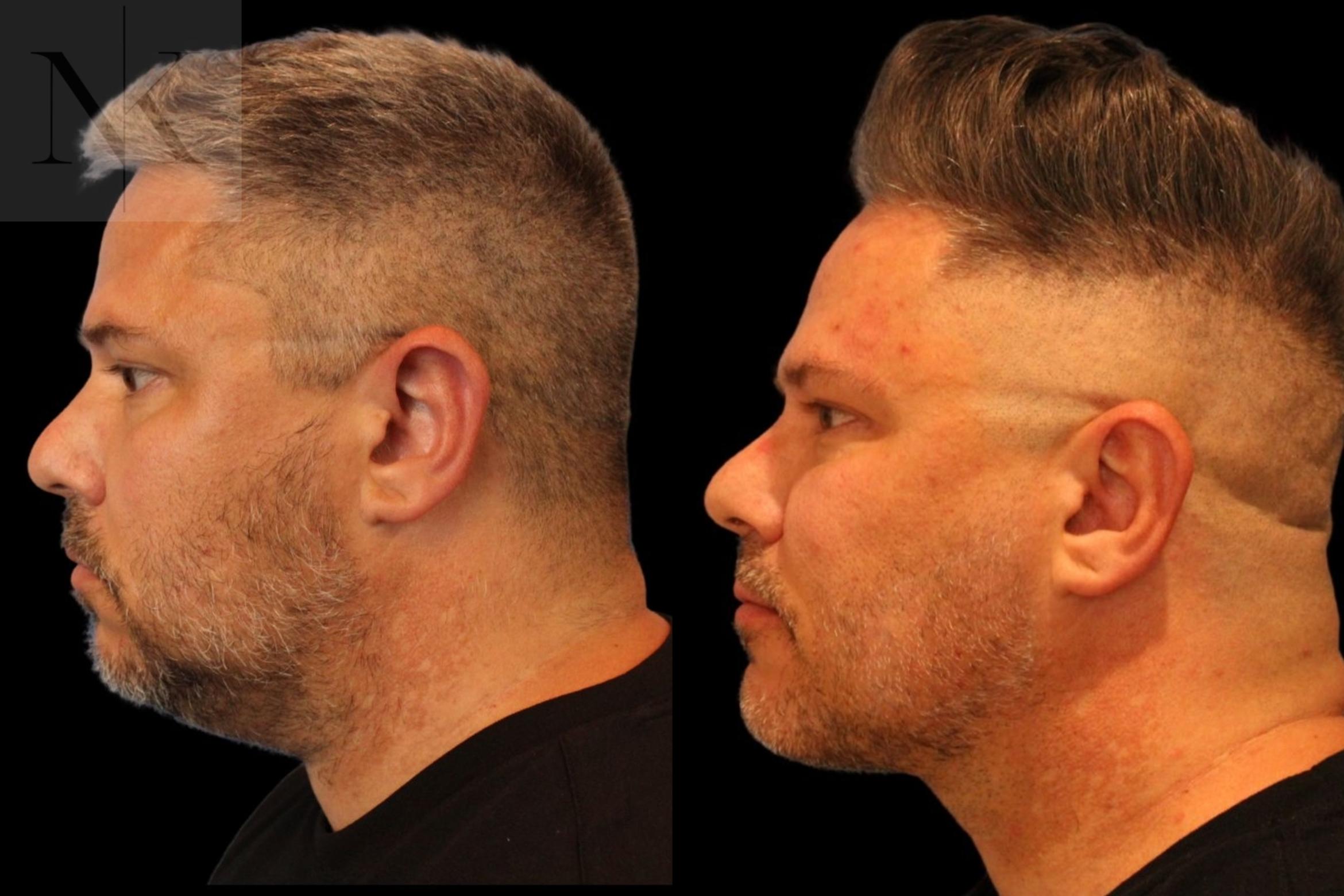Before & After Isolated Deep Neck Lift Case 123 Left Side View in Wethersfield, Hartford, Nebraska