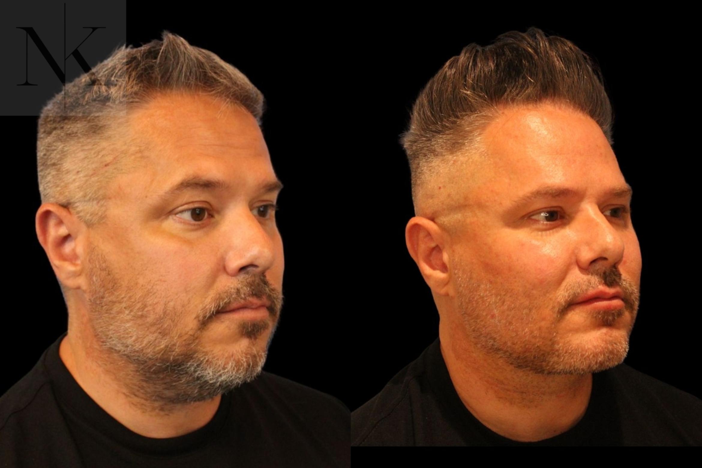 Before & After Isolated Deep Neck Lift Case 123 Right Oblique View in Wethersfield, Hartford, Nebraska