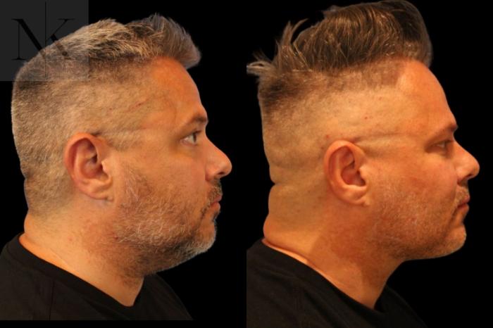 Before & After Isolated Deep Neck Lift Case 123 Right Side View in Wethersfield, Hartford, Nebraska