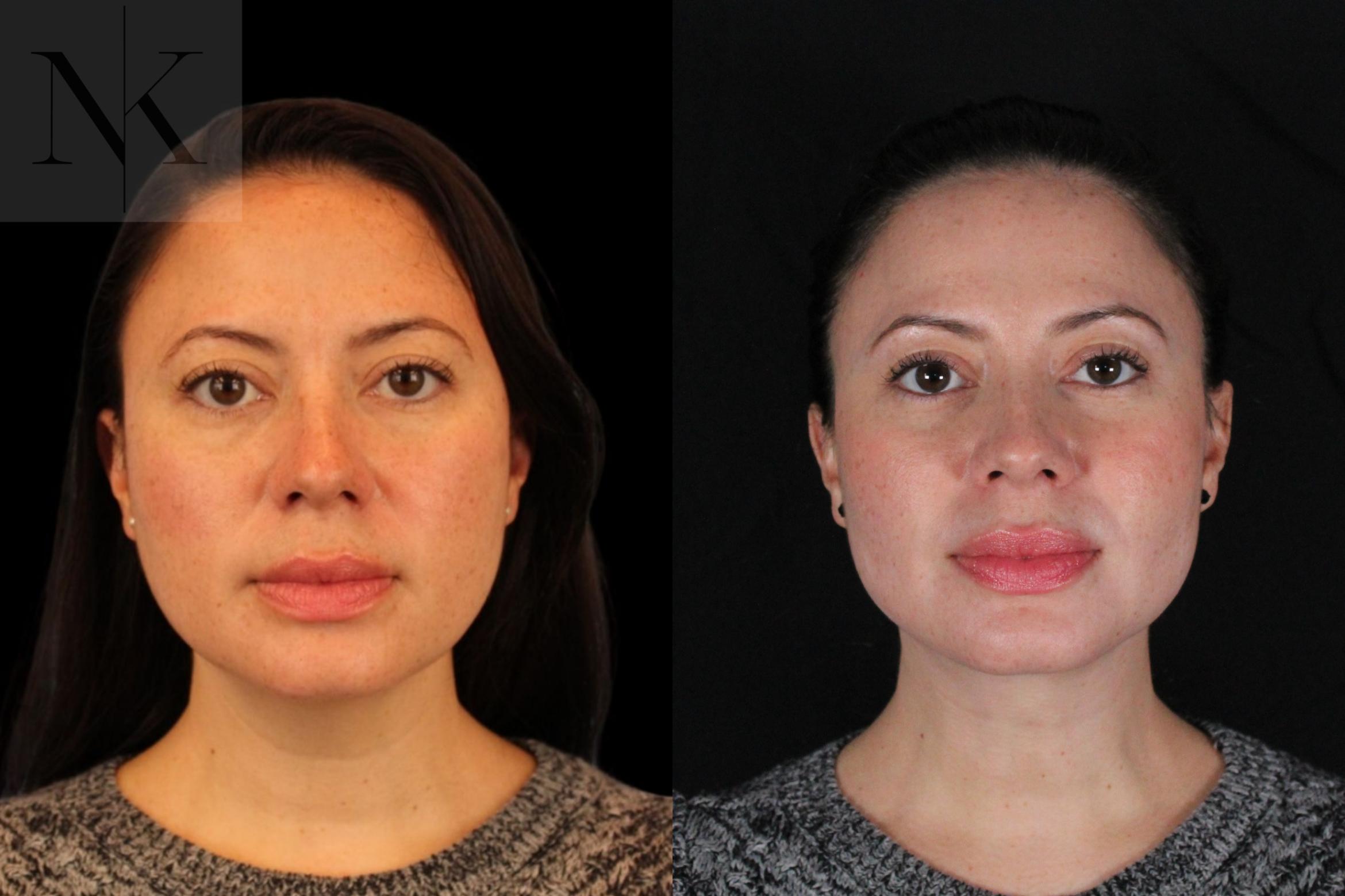 Before & After Isolated Deep Neck Lift Case 124 Front View in Wethersfield, Hartford, Nebraska