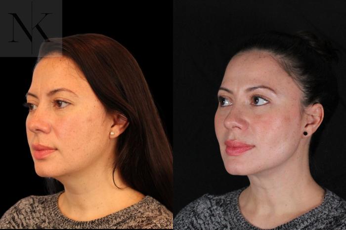 Before & After Isolated Deep Neck Lift Case 124 Left Oblique View in Wethersfield, Hartford, Nebraska