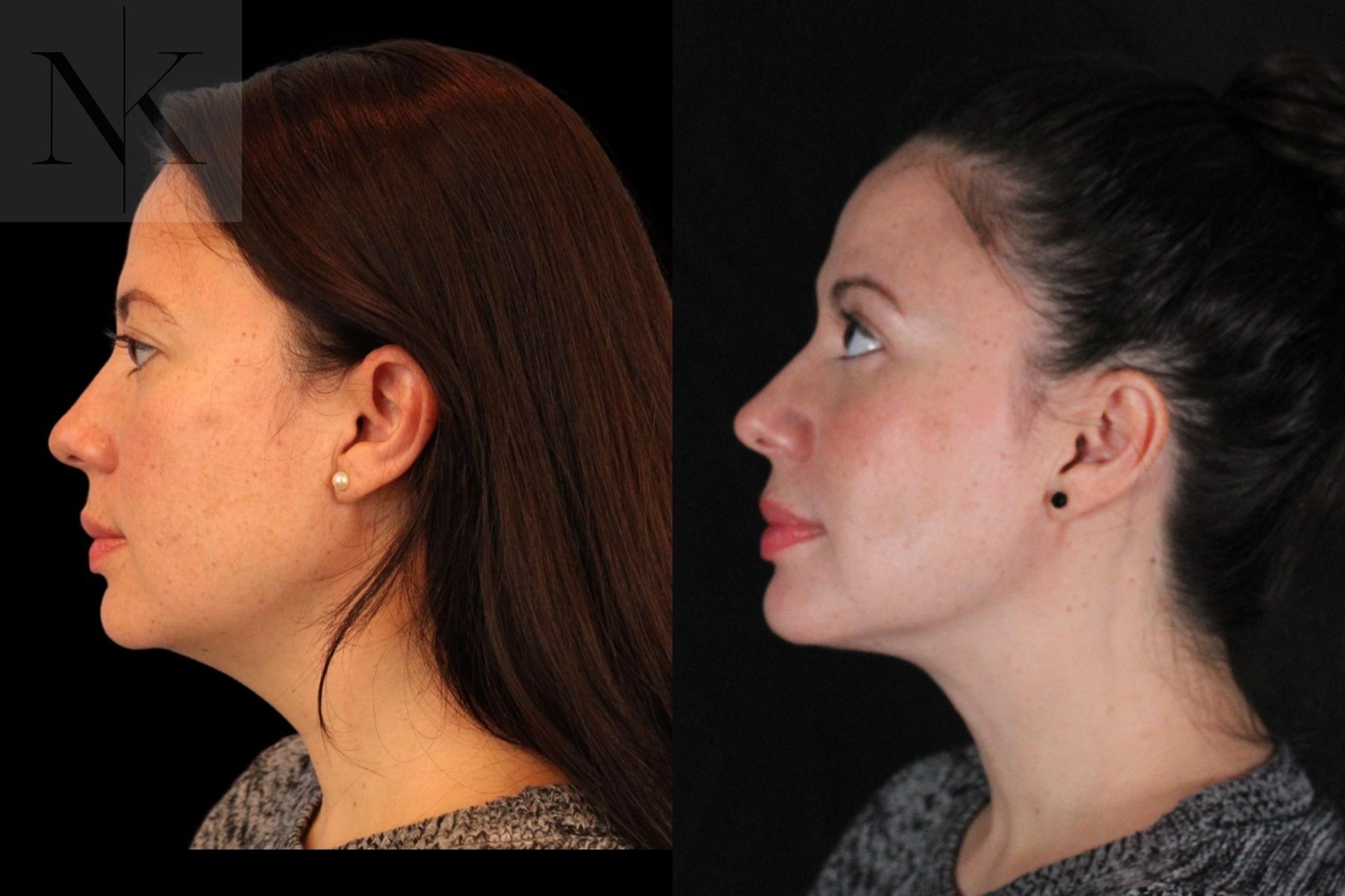 Before & After Isolated Deep Neck Lift Case 124 Left Side View in Wethersfield, Hartford, Nebraska