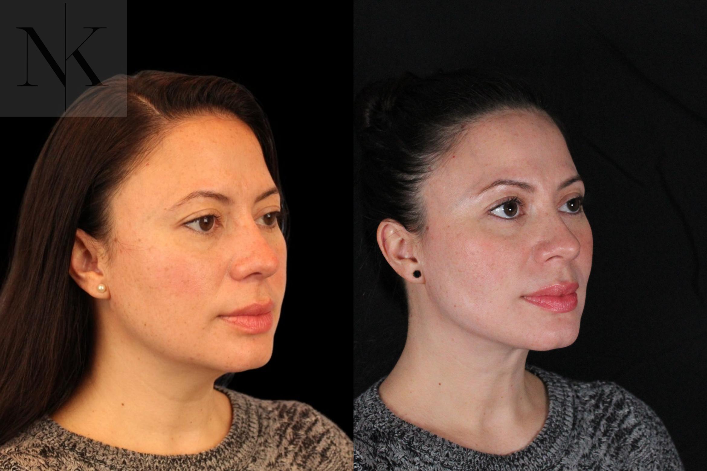 Before & After Isolated Deep Neck Lift Case 124 Right Oblique View in Wethersfield, Hartford, Nebraska