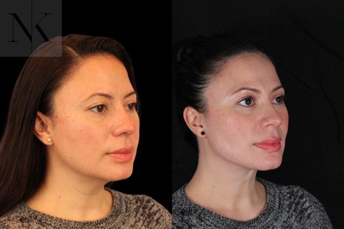 Before & After Isolated Deep Neck Lift Case 124 Right Oblique View in Wethersfield, Hartford, Nebraska