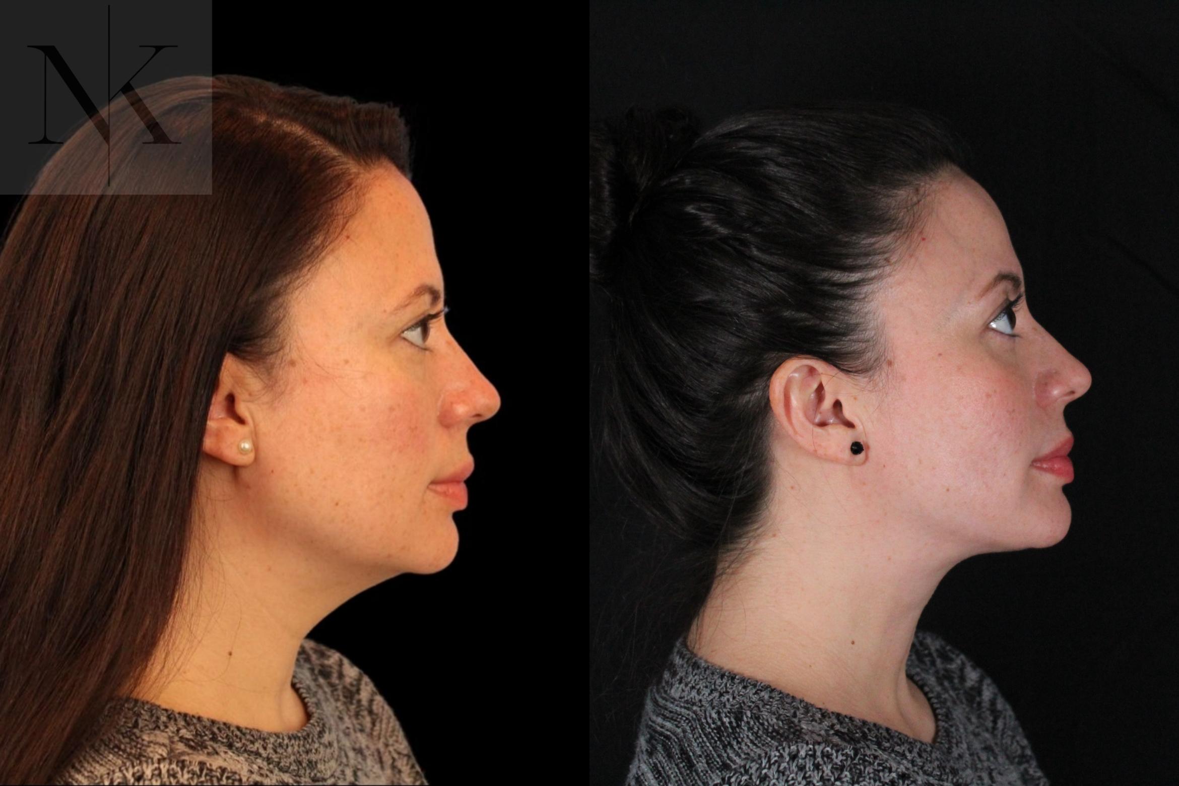 Before & After Isolated Deep Neck Lift Case 124 Right Side View in Wethersfield, Hartford, Nebraska