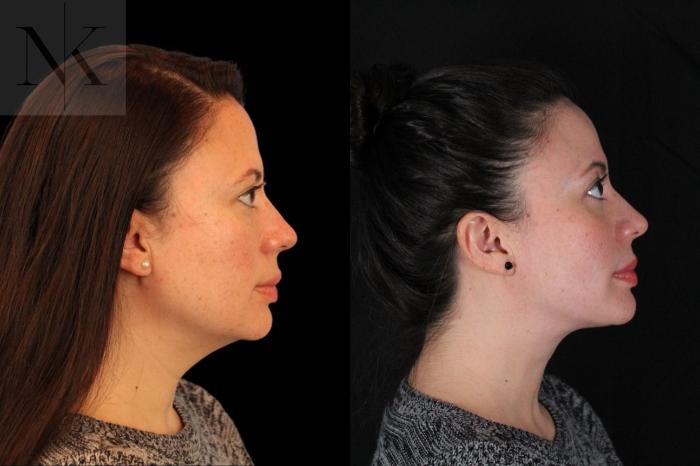 Before & After Isolated Deep Neck Lift Case 124 Right Side View in Wethersfield, Hartford, Nebraska