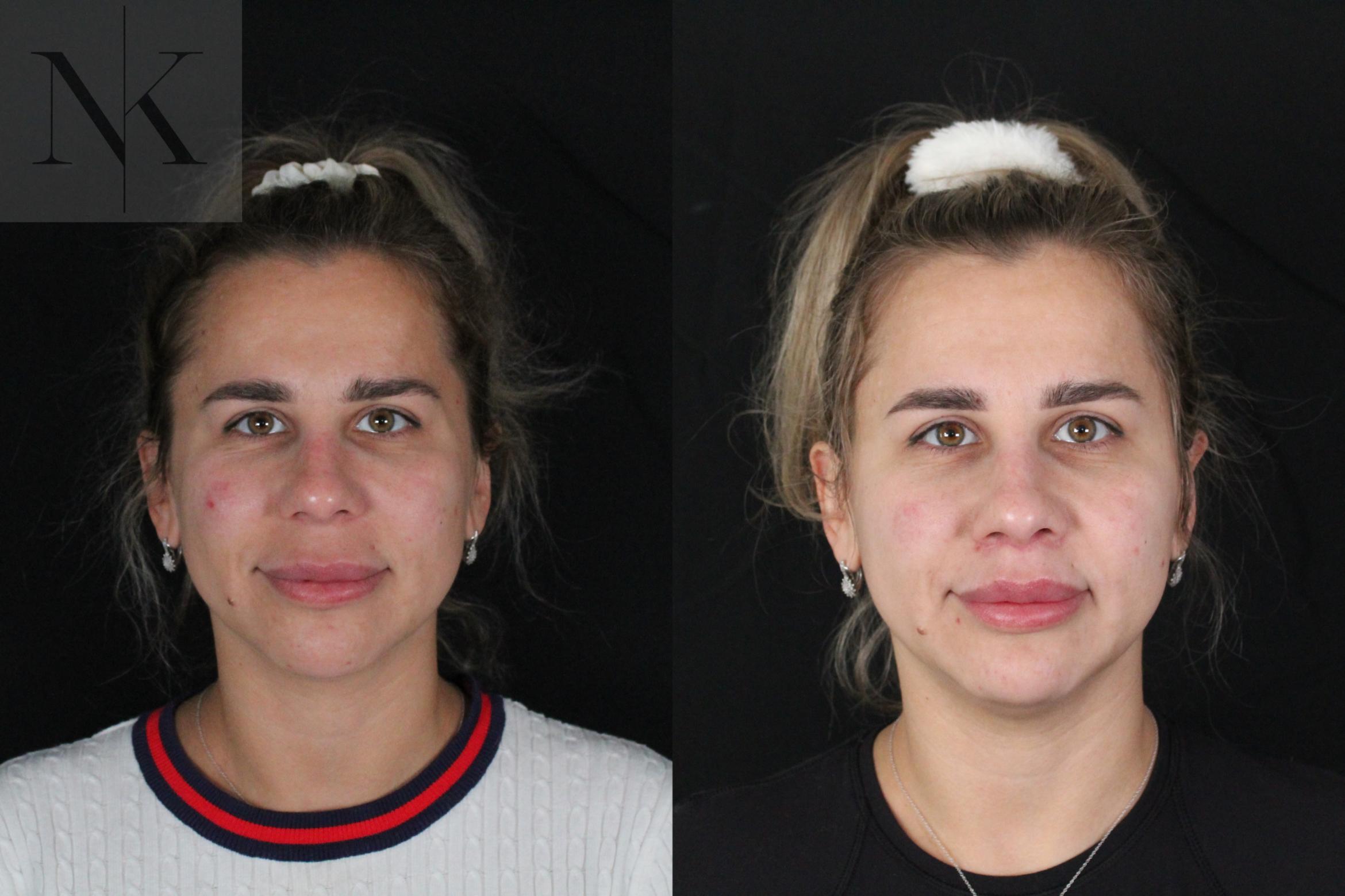Before & After Lip Lift Case 173 Front View in Wethersfield, Hartford, Nebraska