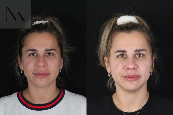 Before & After Lip Lift Case 173 Front View in Wethersfield, Hartford, Nebraska