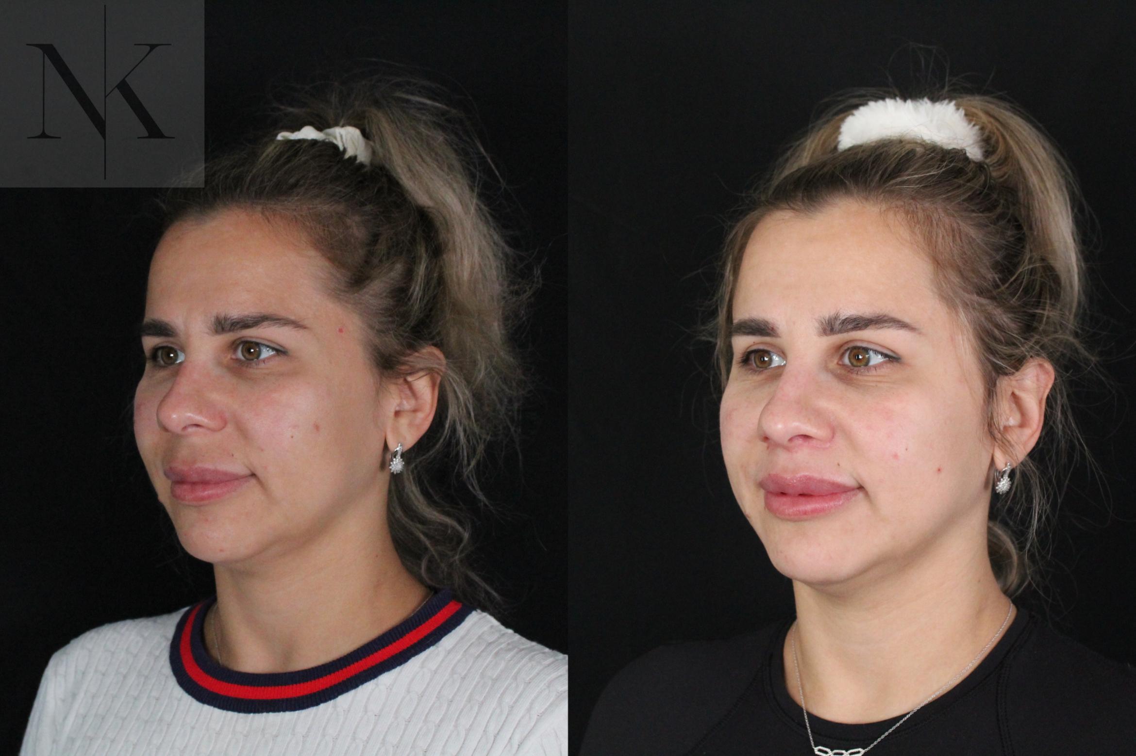 Before & After Lip Lift Case 173 Left Oblique View in Wethersfield, Hartford, Nebraska