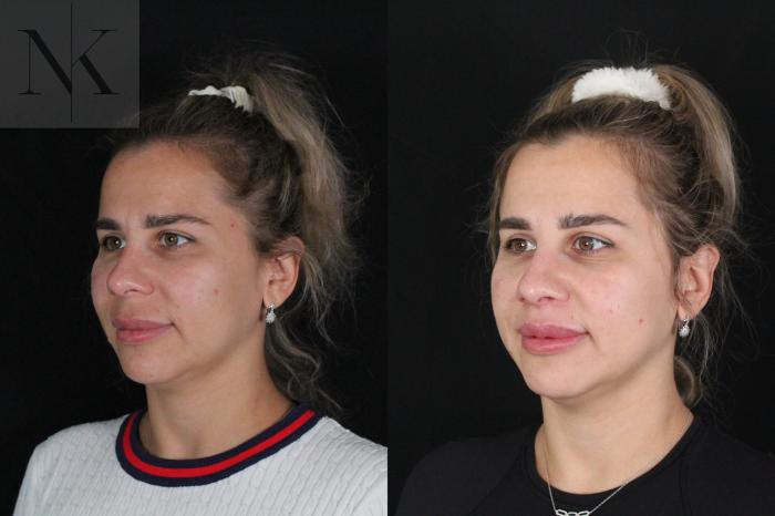 Before & After Lip Lift Case 173 Left Oblique View in Wethersfield, Hartford, Nebraska
