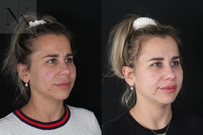 Before & After Lip Lift Case 173 Right Oblique View in Wethersfield, Hartford, Nebraska