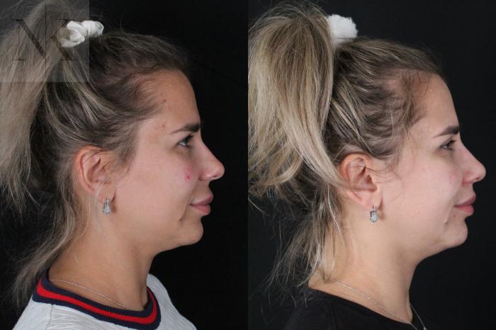 Before & After Lip Lift Case 173 Right Side View in Wethersfield, Hartford, Nebraska
