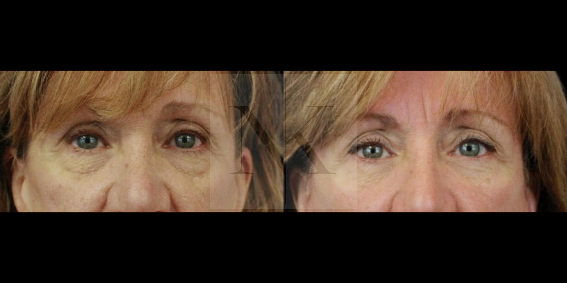 Before & After Lower Blepharoplasty Case 155 Front View in Wethersfield, Hartford, Nebraska