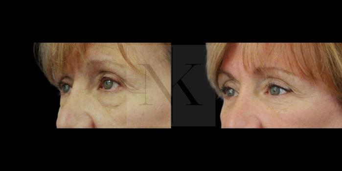 Before & After Lower Blepharoplasty Case 155 Left Oblique View in Wethersfield, Hartford, Nebraska
