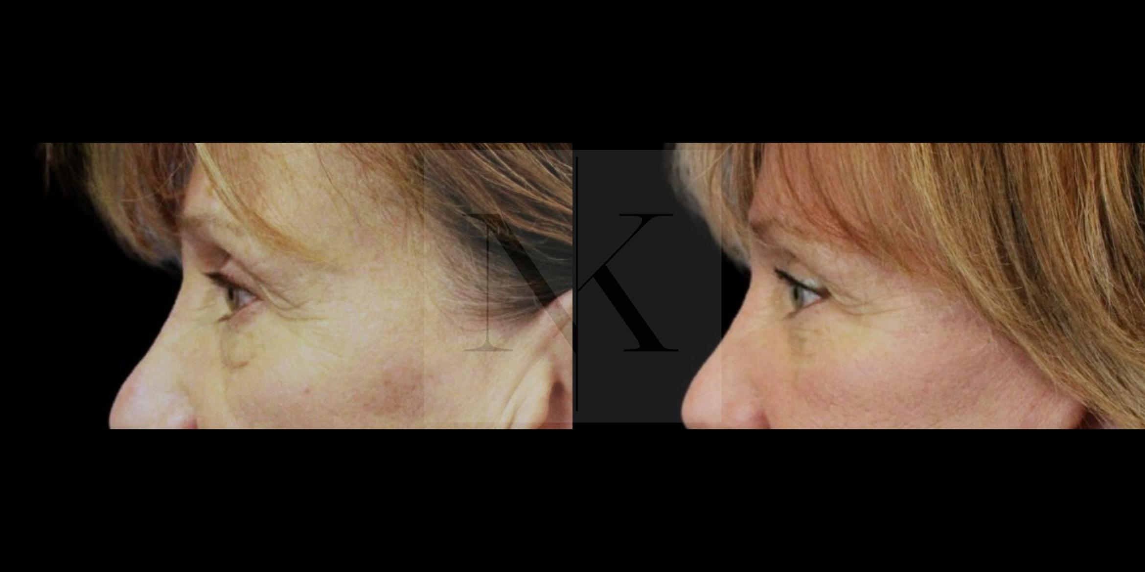 Before & After Lower Blepharoplasty Case 155 Left Side View in Wethersfield, Hartford, Nebraska