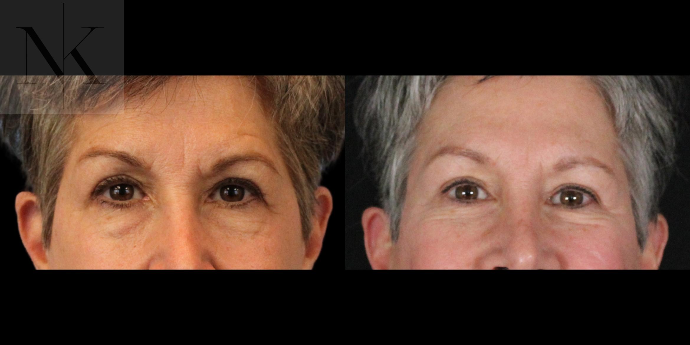 Before & After Brow Lift Case 157 Front View in Wethersfield, Hartford, Nebraska