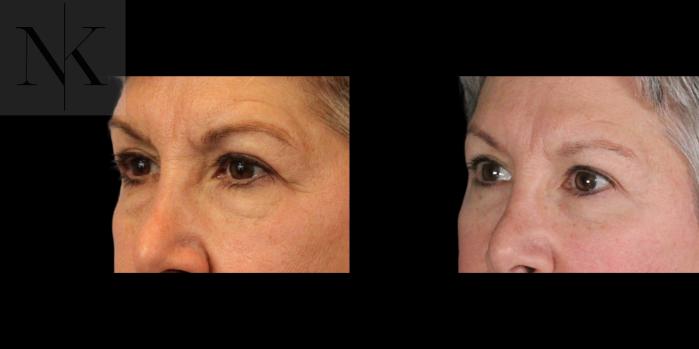 Before & After Brow Lift Case 157 Left Oblique View in Wethersfield, Hartford, Nebraska