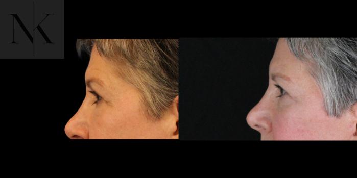 Before & After Brow Lift Case 157 Left Side View in Wethersfield, Hartford, Nebraska