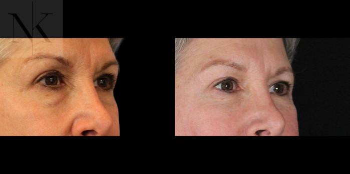 Before & After Brow Lift Case 157 Right Oblique View in Wethersfield, Hartford, Nebraska