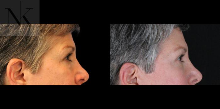 Before & After Brow Lift Case 157 Right Side View in Wethersfield, Hartford, Nebraska