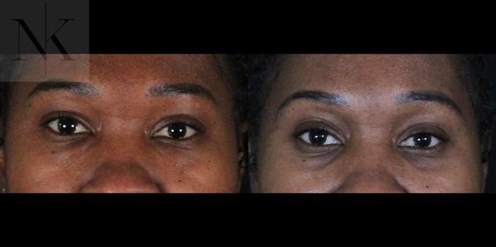 Before & After Lower Blepharoplasty Case 174 Front View in Wethersfield, Hartford, Nebraska
