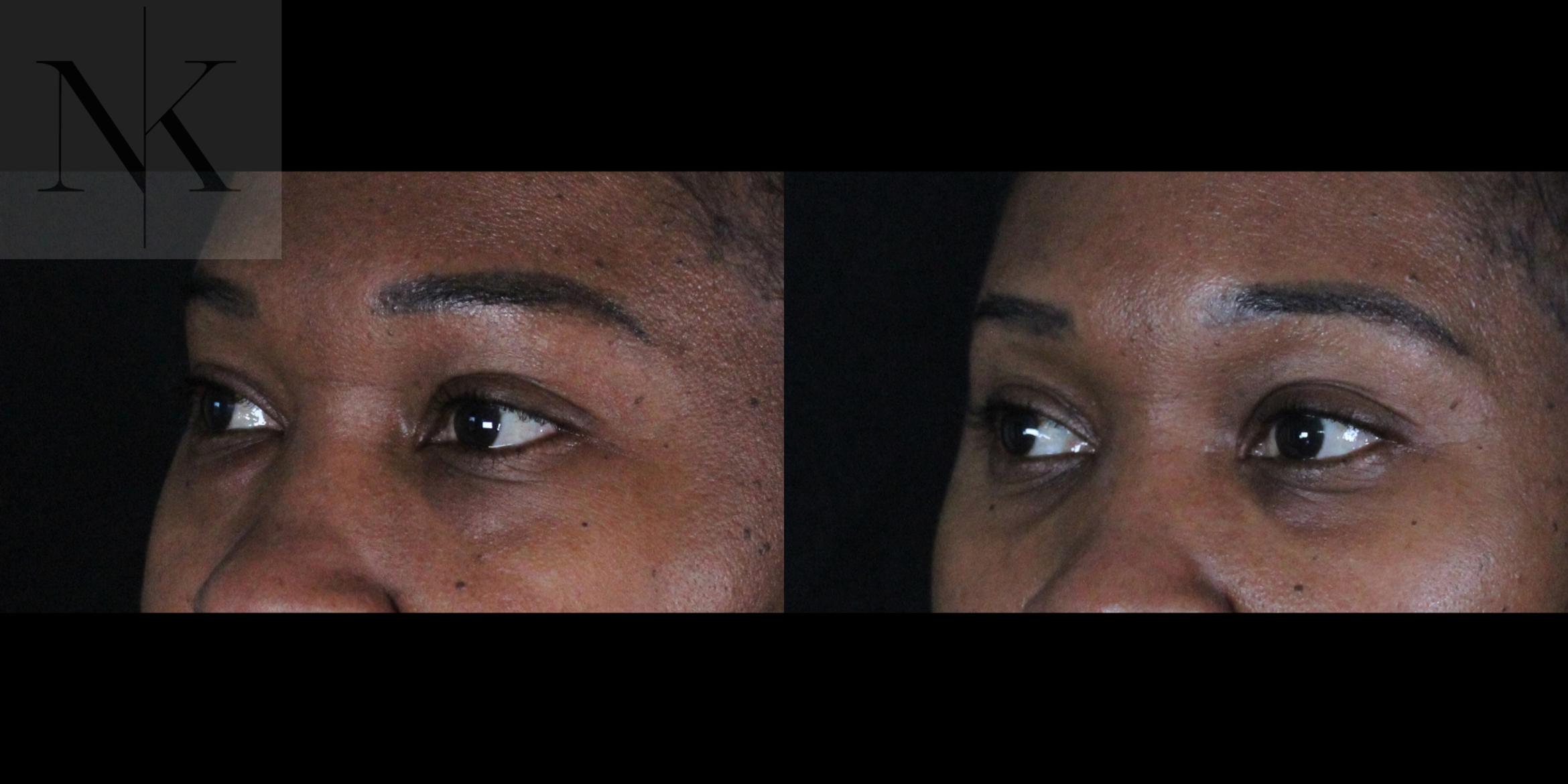 Before & After Lower Blepharoplasty Case 174 Left Oblique View in Wethersfield, Hartford, Nebraska