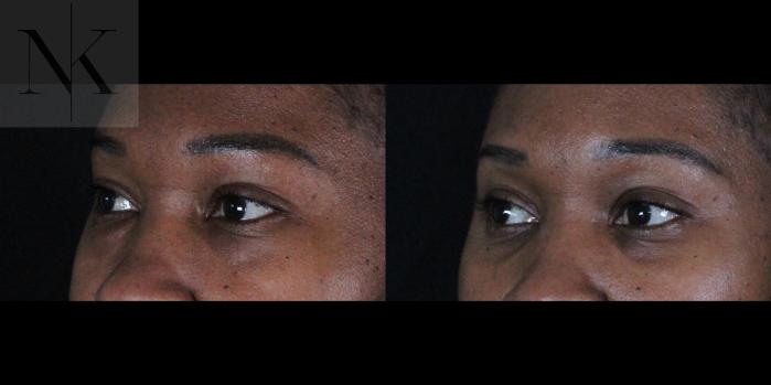 Before & After Lower Blepharoplasty Case 174 Left Oblique View in Wethersfield, Hartford, Nebraska
