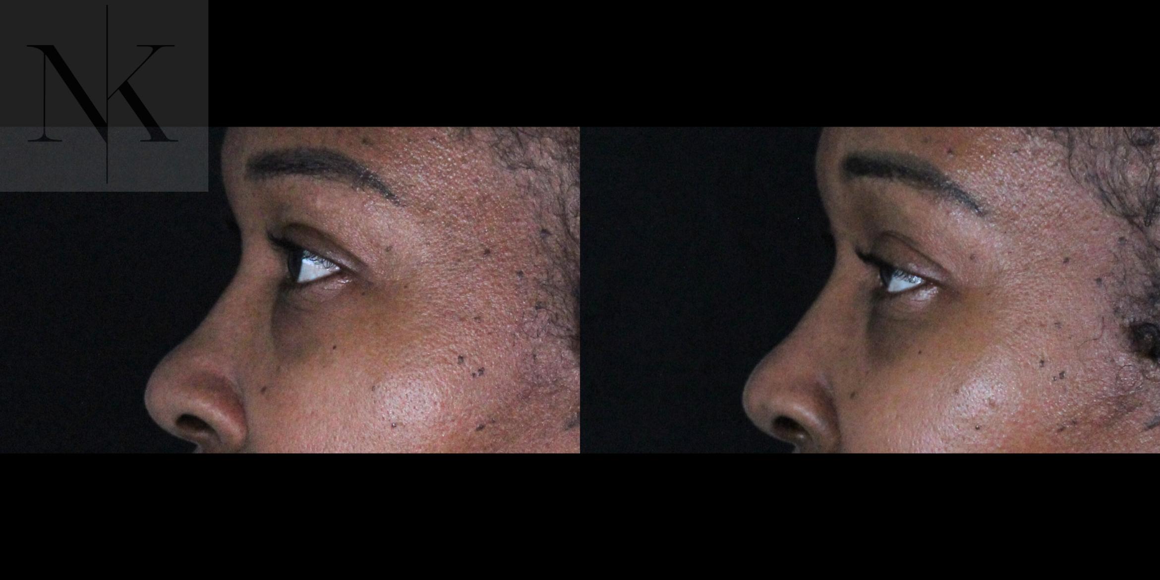 Before & After Lower Blepharoplasty Case 174 Left Side View in Wethersfield, Hartford, Nebraska