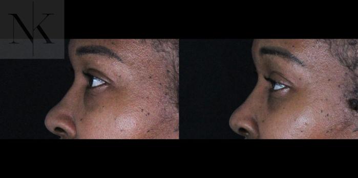Before & After Lower Blepharoplasty Case 174 Left Side View in Wethersfield, Hartford, Nebraska