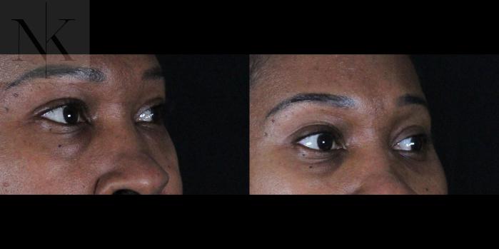 Before & After Lower Blepharoplasty Case 174 Right Oblique View in Wethersfield, Hartford, Nebraska