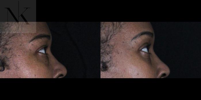 Before & After Lower Blepharoplasty Case 174 Right Side View in Wethersfield, Hartford, Nebraska