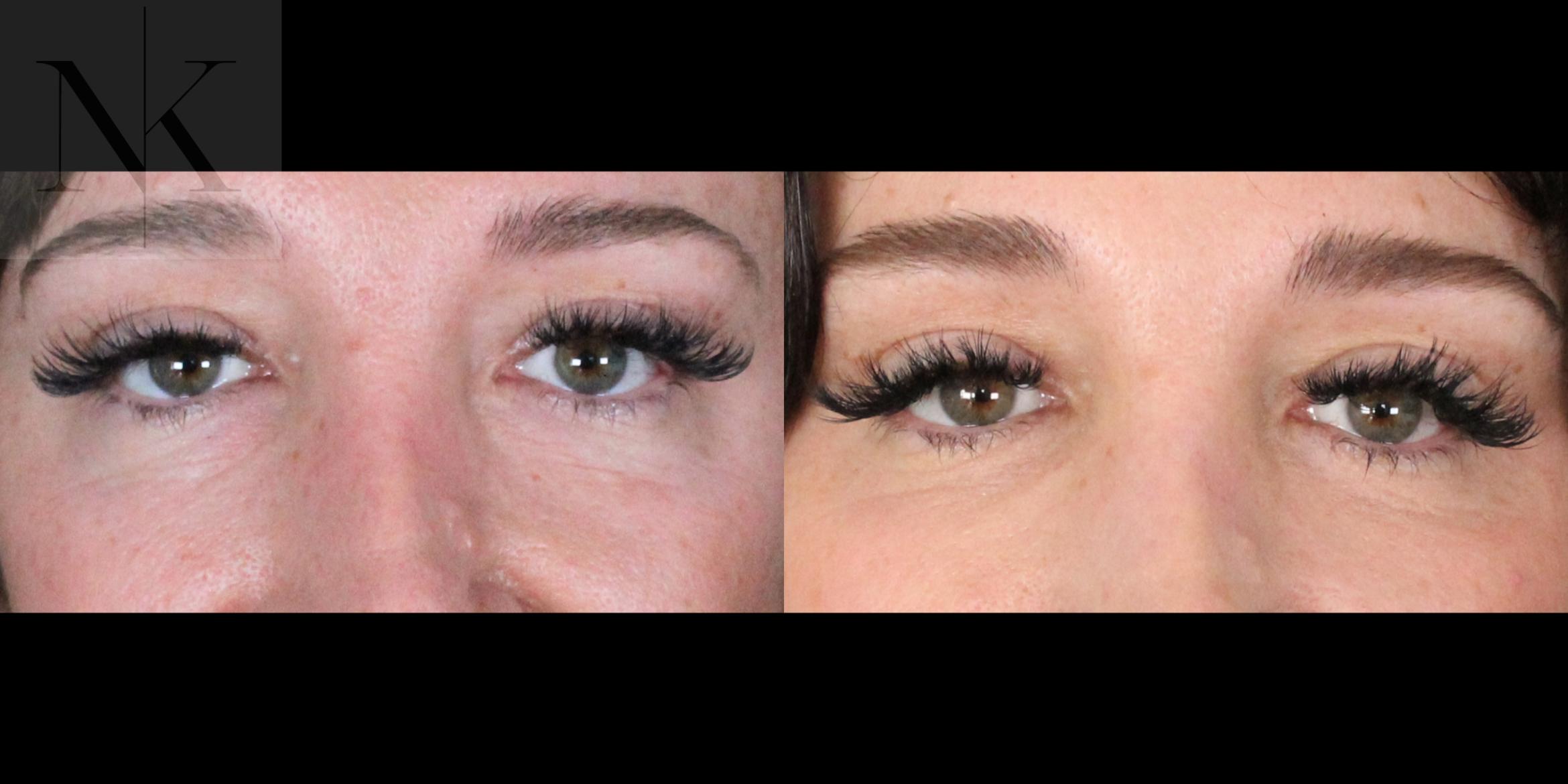 Before & After Lower Blepharoplasty Case 175 Front View in Wethersfield, Hartford, Nebraska